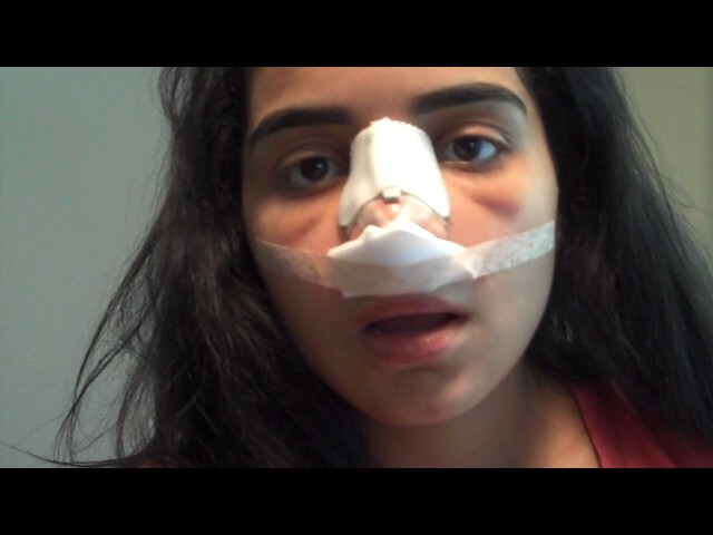 Hispanic Ethnic Rhinoplasty Postoperative 1 Week Diary in Dallas, Texas