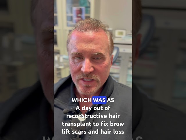 A day out of reconstructive hair transplant to fix brow lift scars and hair loss