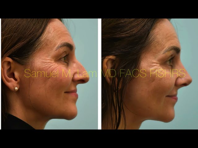Rhinoplasty One Month Testimonial and Follow Up