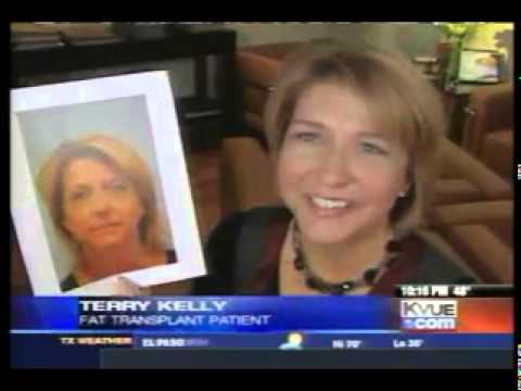 Fat Grafting Featured On Kvue Abc In Austin, Texas