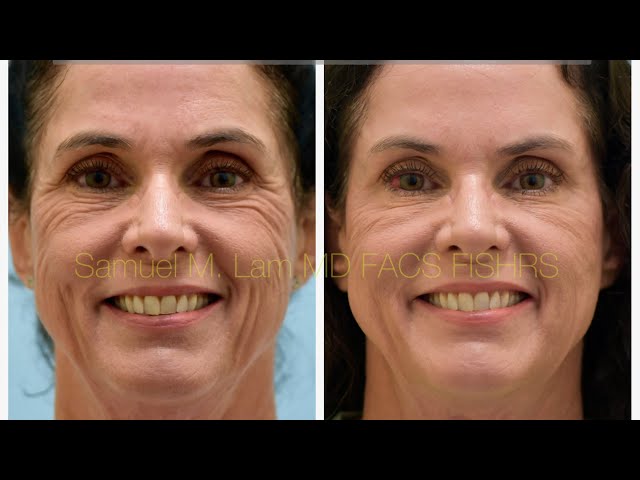 Dynamic Filler, MesoBotox Testimonial