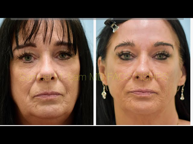 Dallas RF Microneedle, Botox, MesoBotox Testimonial to Correct Smoker’s Skin