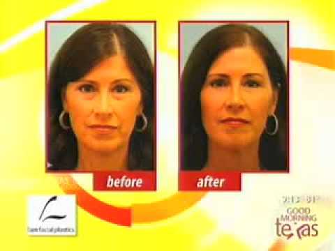 Good Morning Texas On Incisionless Facial Rejuvenation, Fat Vs. Fillers