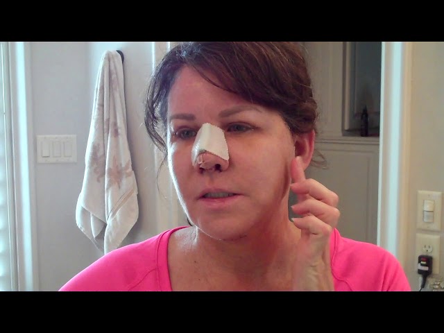 Dallas Deep-Plane Facelift, Rhinoplasty, & Upper Eyelid Recovery Video First Week