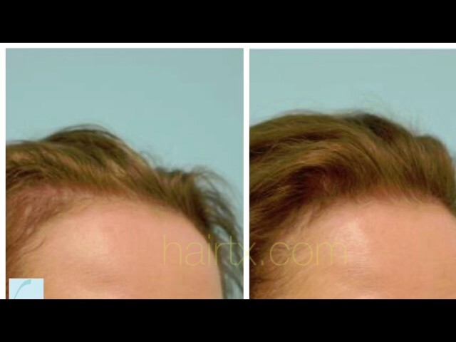 Low-Level Laser Hair Restoration Testimonial in Dallas, Texas