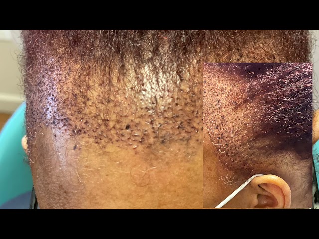 Dallas Ethnic Female Hair Transplant Testimonial