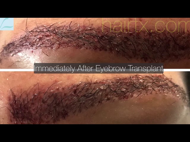 African American Eyebrow Transplant Testimonial