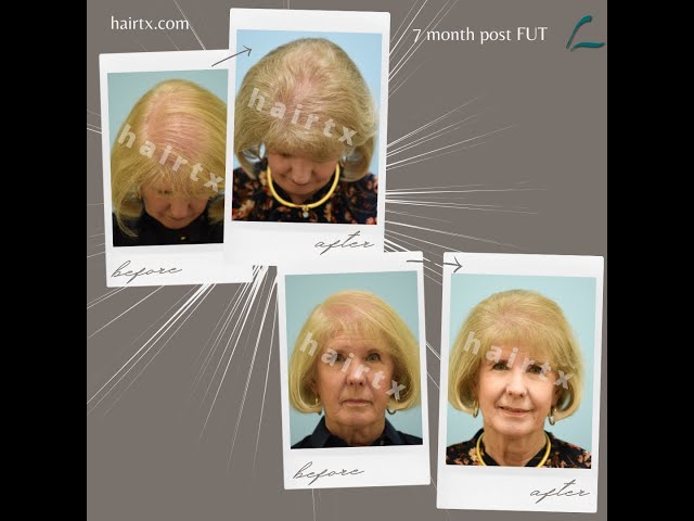Dallas Hair Transplant | Patient Testimonial - 7 Months Post Hair Transplant