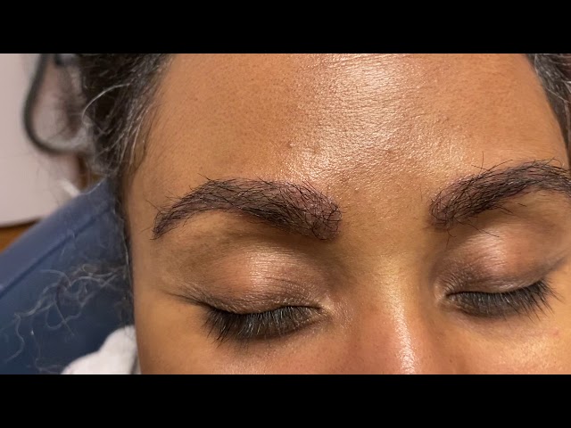 Dallas African-American Eyebrow & Hairline Transplant 2 Weeks Out