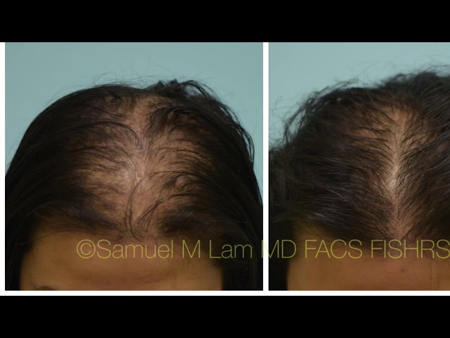 Dallas PRP Hair Loss Testimonial