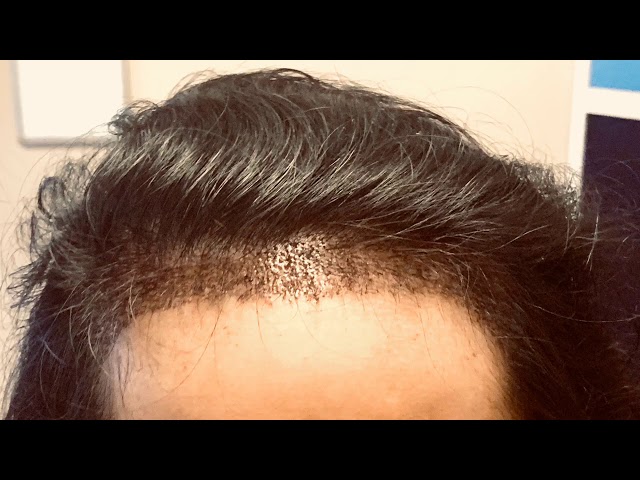 Dallas Female Hairline Lowering Testimonial