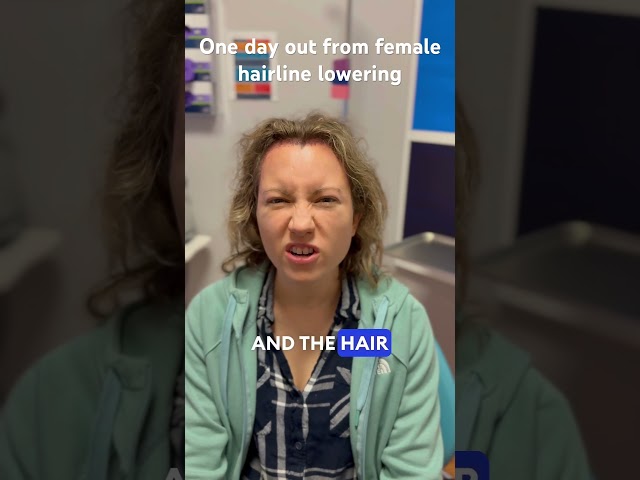 One day out from female hairline lowering