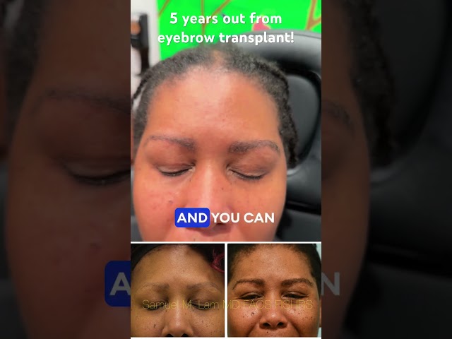 5 years out from eyebrow transplant!