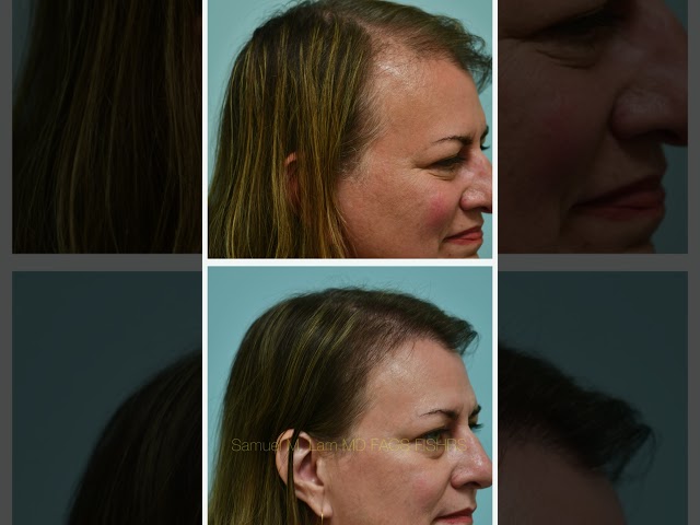 6 months postop female hair transplant testimonial and photos.