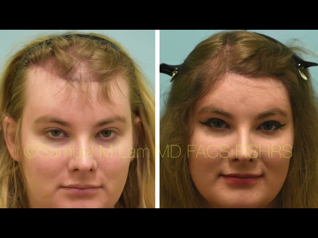 MTF Transgender Hair Transplant Testimonial in Dallas, Texas with Photos