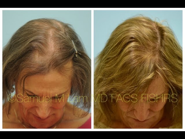 Dallas MTF Transgender Hair Transplant Front to Back 1 Year Out Testimonial + Photos