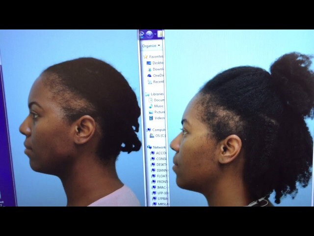 African-American Hair Transplant Early Result + View of Donor Incision
