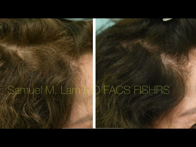 Hair Stem “PRP 2.0” Testimonial