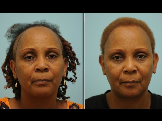 African-American Hair Transplant to Correct Chemotherapy Hair Loss Testimonial in Dallas, TX
