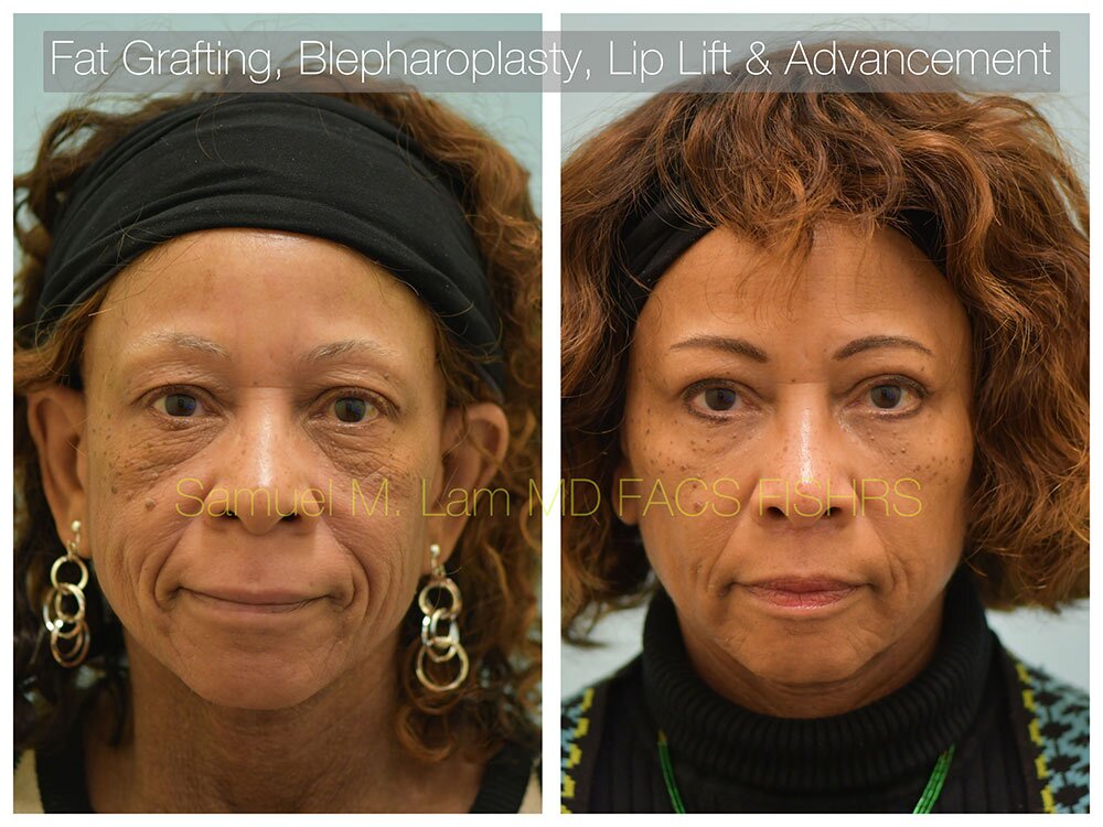 Lower Bleph Before and After patient