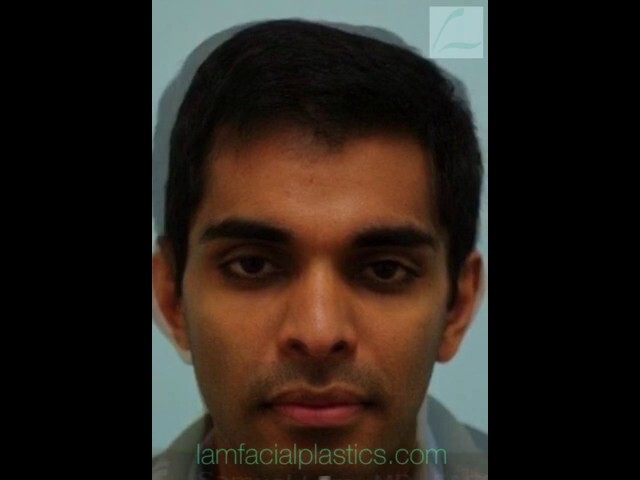 Otoplasty Video Transformation in Dallas, Texas