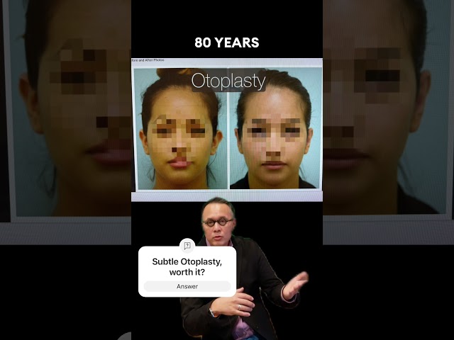 Subtle Otoplasty.  Worth it?