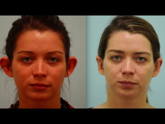 Dallas Otoplasty Testimonial 7 Years Out in 4K