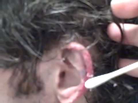 OTOPLASTY DALLAS (COSMETIC EAR PINNING):  HELIX ...