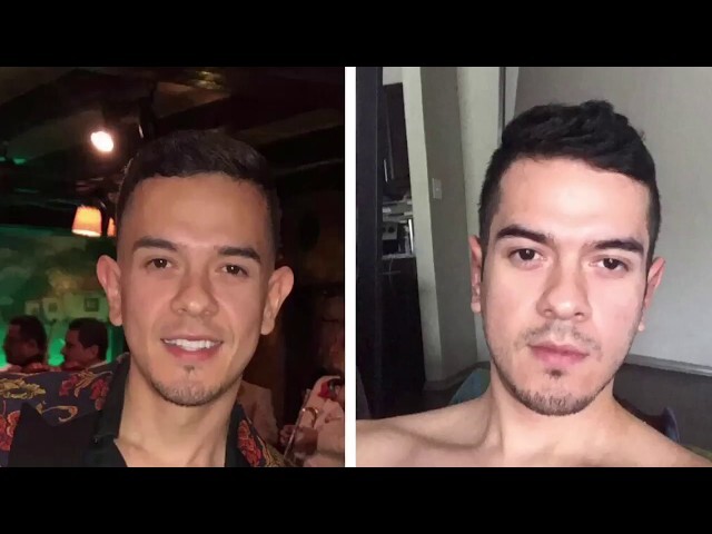 Dallas Otoplasty Testimonial with Photos