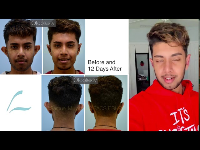 Dallas Otoplasty Recovery Video with Before and After