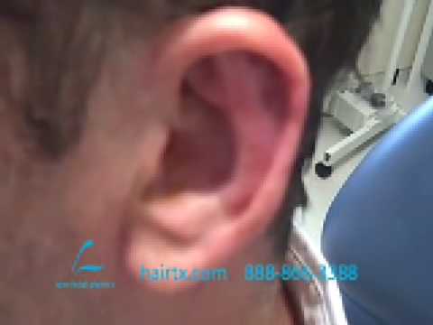 ONE-SIDED (UNILATERAL) OTOPLASTY COSMETIC EAR PINNING DALLAS