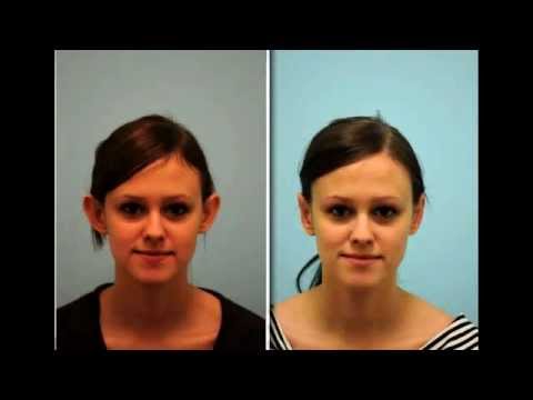 Otoplasty Testimonial in Dallas, Texas by Dr. Sam Lam