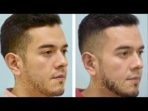Dallas Otoplasty Testimonial with Photos
