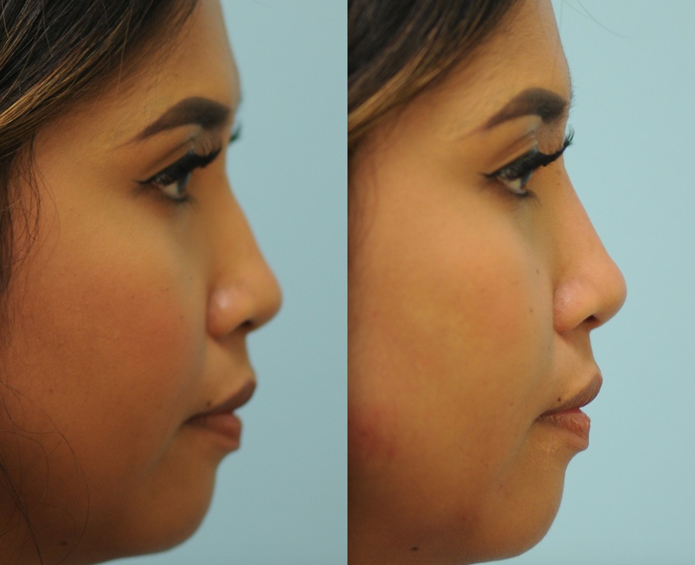 Restylane Lyft Photos