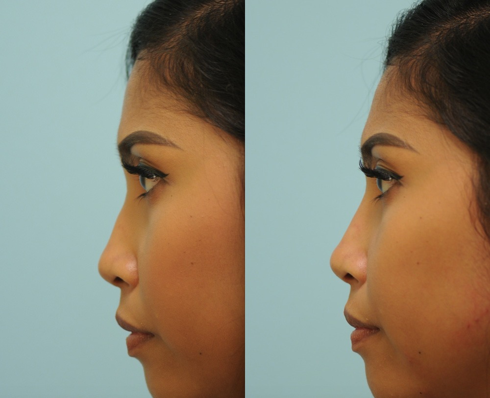Restylane Lyft Photos