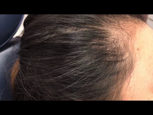 Asian Rhinoplasty Temporalis Fascia & Cartilage Donor Incision Views