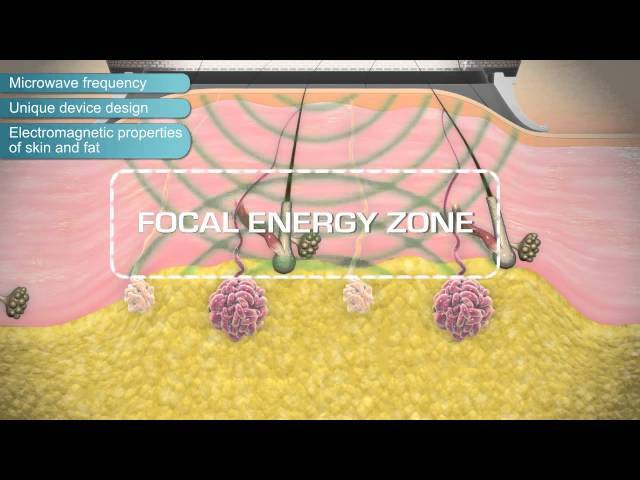 miraDry A Cure For Underarm Sweating