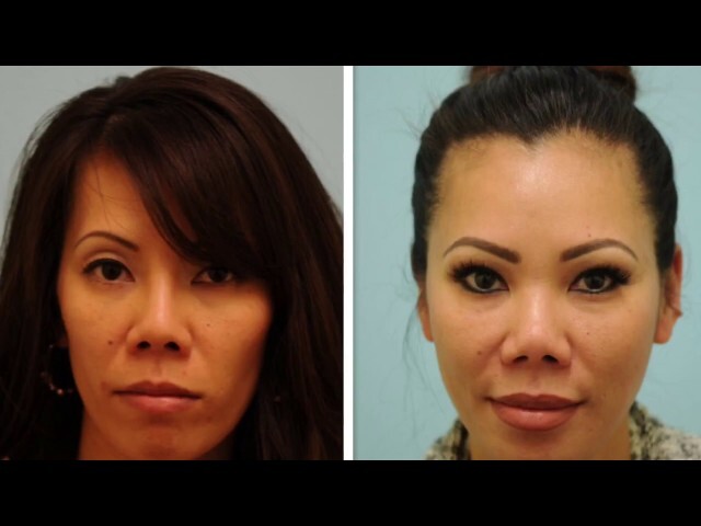 Asian Blepharoplasty, Revision Rhinoplasty, Fat Grafting Testimonial