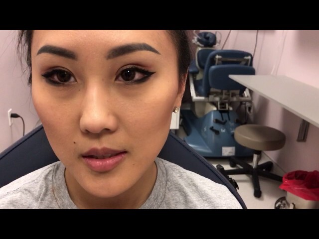 Dallas Asian Double Eyelid Blepharoplasty 5 Weeks Out