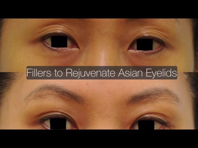 Aging Asian Eyelid Multiple Fold Correction with Fillers