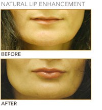 lip_augumentation