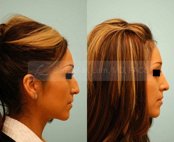 Hooked Nose Rhinoplasty Photos