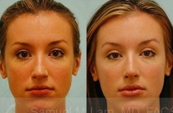 Hooked Nose Rhinoplasty Photos