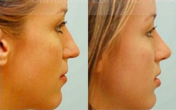 Hooked Nose Rhinoplasty Photos