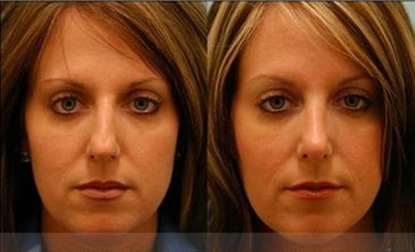 Hooked Nose Rhinoplasty Photos