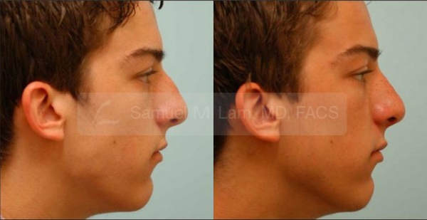 Hooked Nose Rhinoplasty Photos