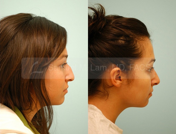 Hooked Nose Rhinoplasty Photos