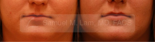 Lip Augmentation Photos