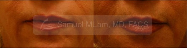 Lip Augmentation Photos