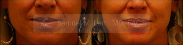 Lip Augmentation Photos